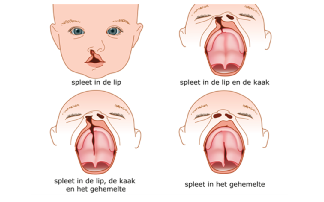 Logopedie bij kinderen met schisis